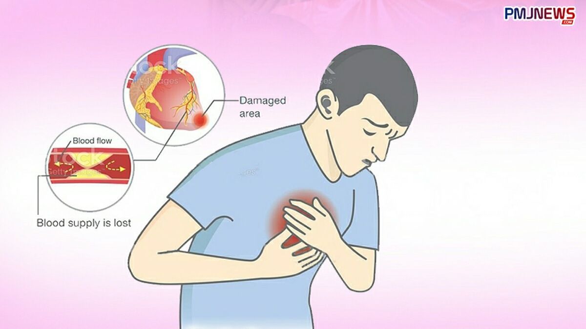 Ilustrasi orang yang sedang terserang penyakit jantung. Serangan jantung yang sering disepelekan dapat merenggut nyawa./Ilustrasi/Hadi
