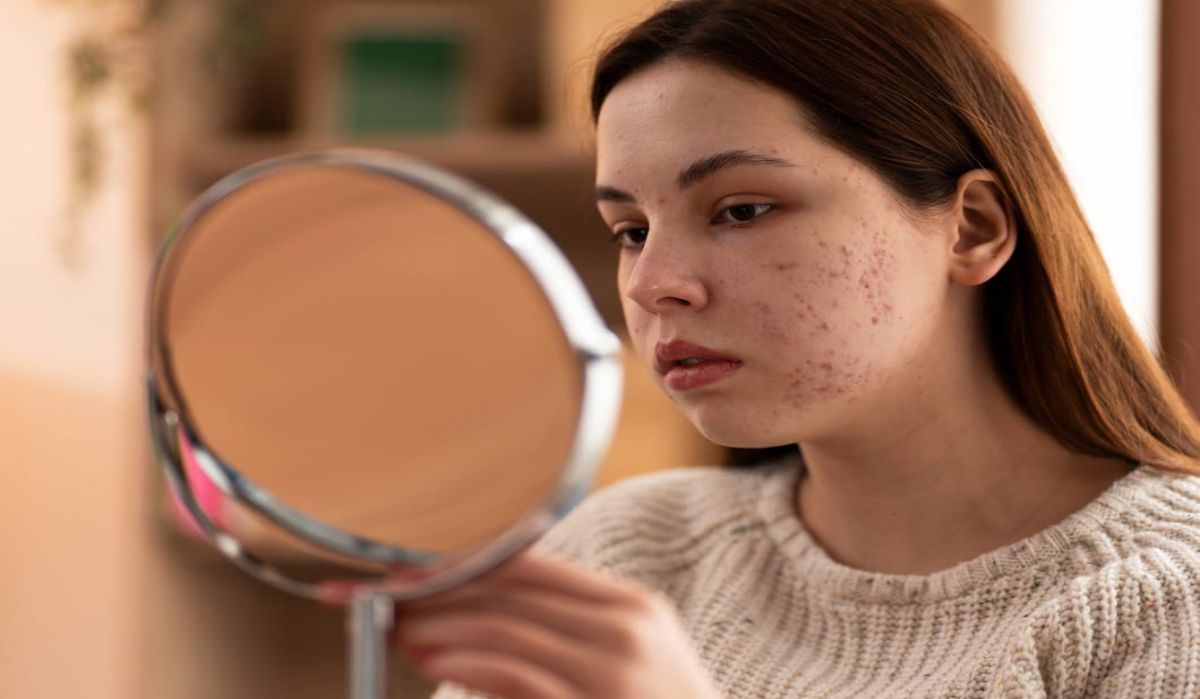Skincare yang Aman dan Efektif untuk Kulit Sensitif Berjerawat