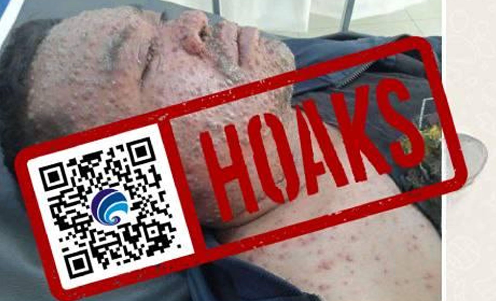 Hoax Pj Bupati Brebes terpapar virus Cacar Monyet