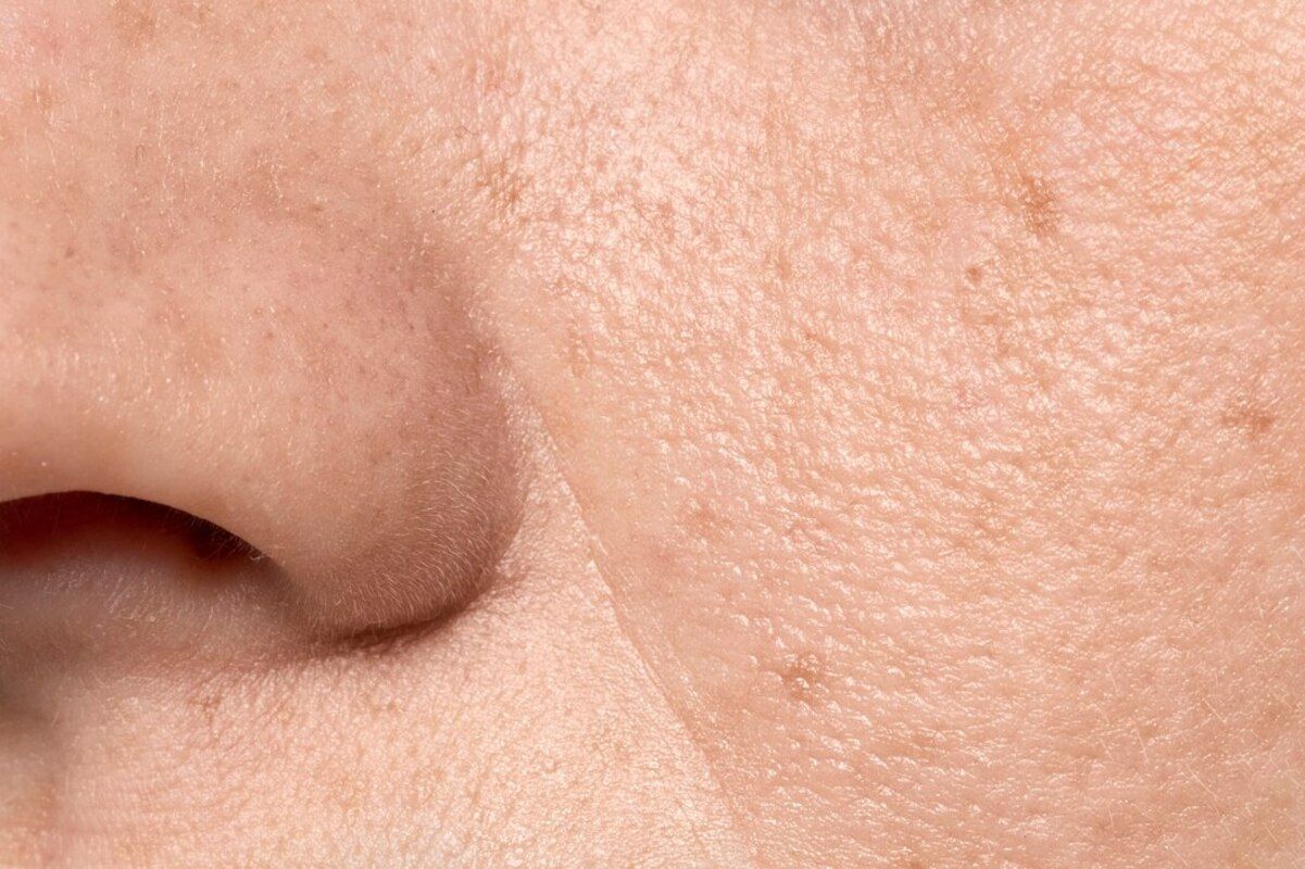 Berikut perbedaan sebaceous filaments dengan komedo, lengkap dengan cara membersihkannya