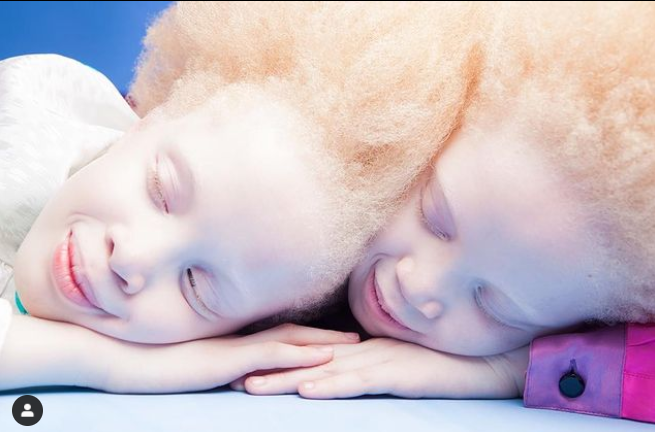 Mara dan Lara manusia Albino