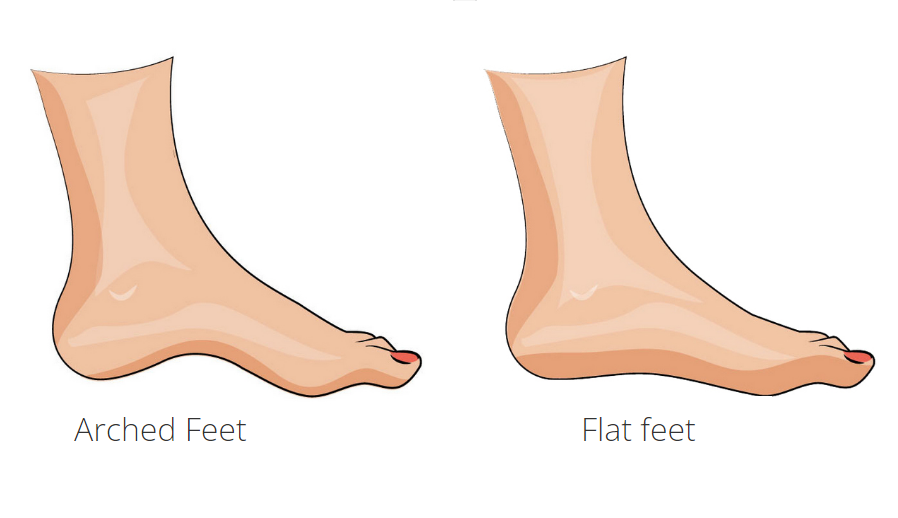 Ilustrasi bentuk telapak kaki melengkung dan telapak kaki datar.