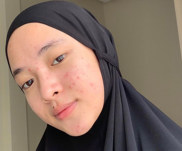 Nissa Sabyan Unggah Foto Berjerawat Netizen Salah Pilih Suami Orang