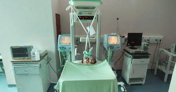 Bayi Kembar Siam Satu Tubuh Dua Kepala di Padang Sumbar Meninggal Setelah Perawatan Intensif
