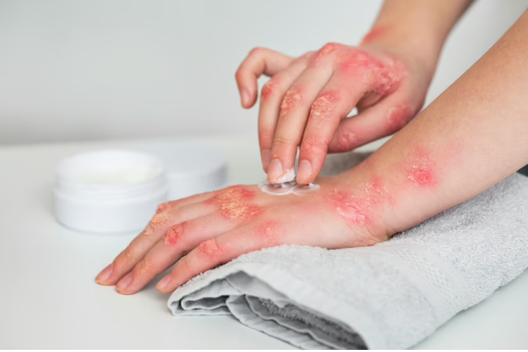 Kenali Penyakit Psoriasis Vulgaris, Penyebab, Serta Gejalanya - Oke Flores