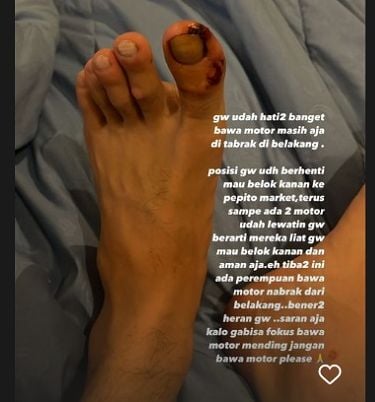 Kondisi kaki aktor Stefan William yang diunggah di Instagram