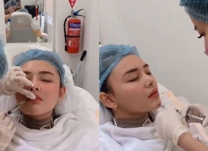 Amanda Manopo saat melakukan treatment bibir 