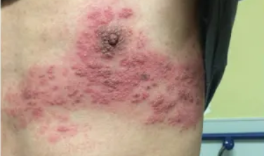 Gejala herpes
