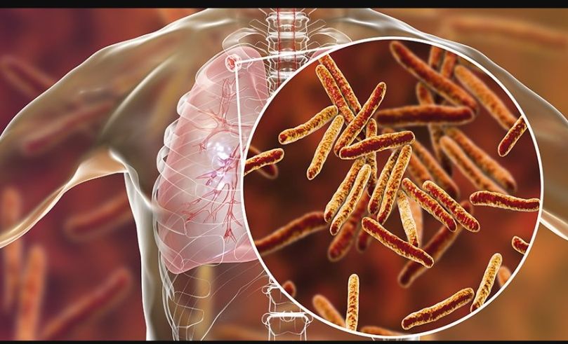 Penyakit tuberkulosis atau tbc adalah penyakit yang menyerang saluran