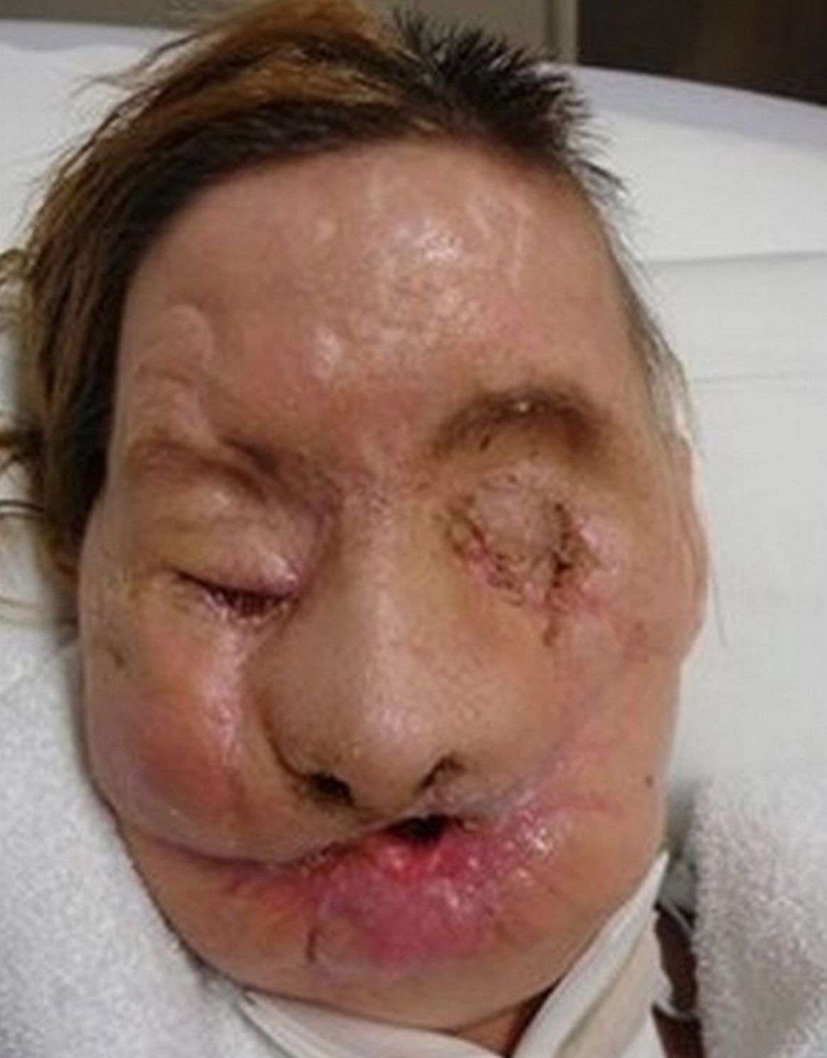 Korban menjalani transplantasi wajah dua tahun setelah serangan itu.  