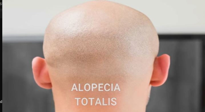 Alopecia Totalis, 