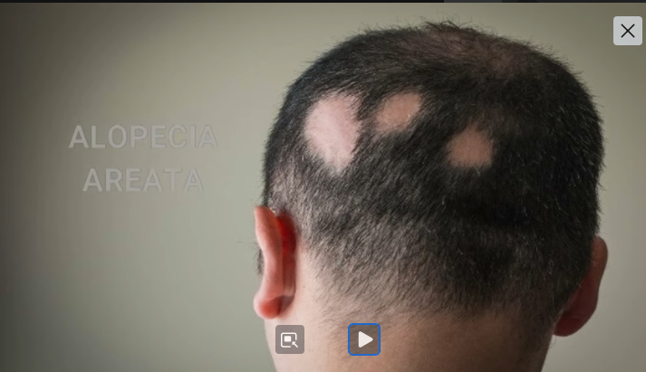 Alopecia Areata, salah satu jenis Alopecia 